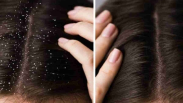 Can Dandruff Cause Hair Fall