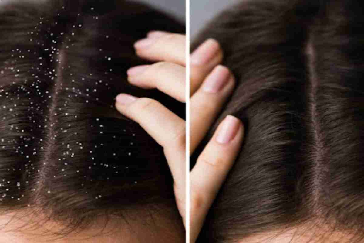 Can Dandruff Cause Hair Fall