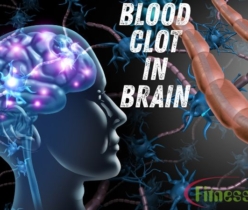 Blood Clot in Brain