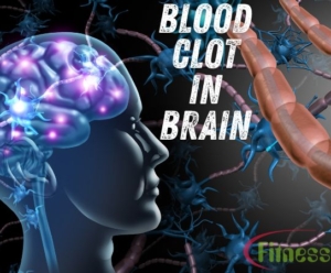 Blood Clot in Brain