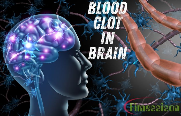 Blood Clot in Brain